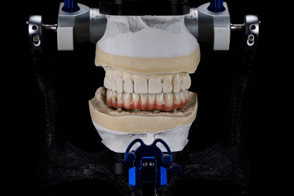 Ceramic prosthesis mounted on plaster models in an articulator