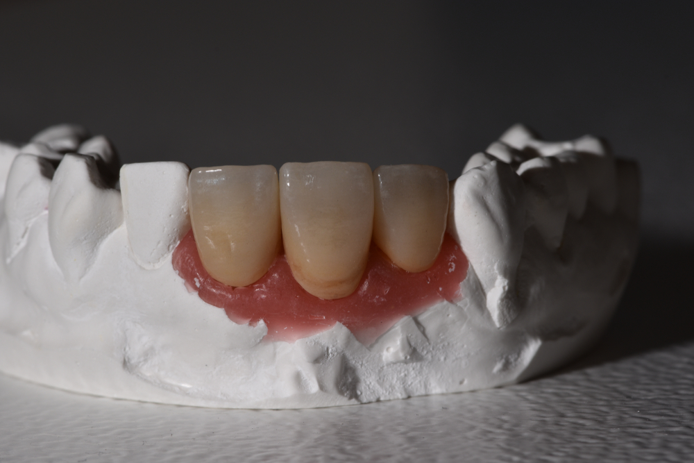 Anterior zirconia crowns seated on a plaster model