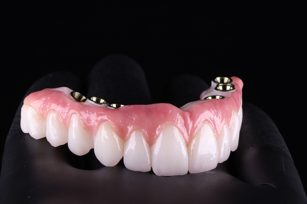 Full-arch zirconia implant prosthesis seen from the side