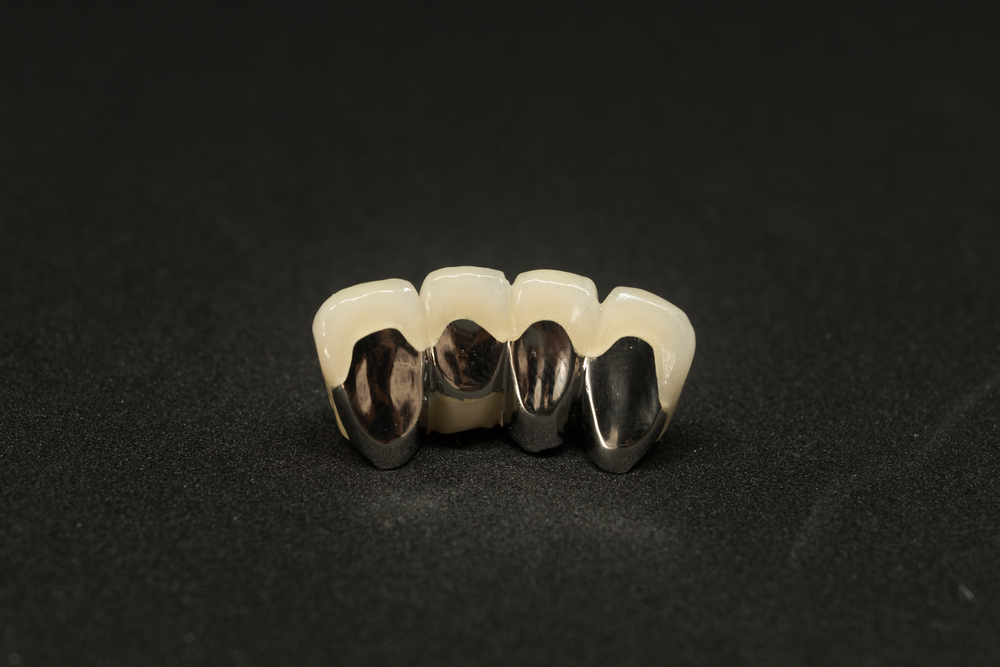 Porcelain-fused-to-metal bridge seen from the lingual side, showing the metal substructure