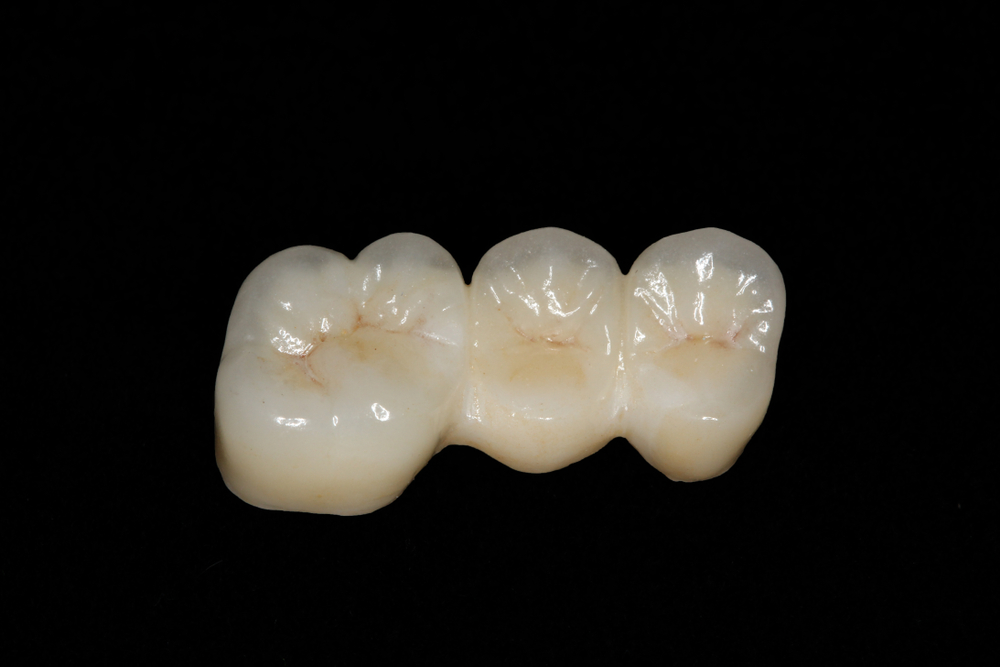 Three-unit zirconia bridge on a black background